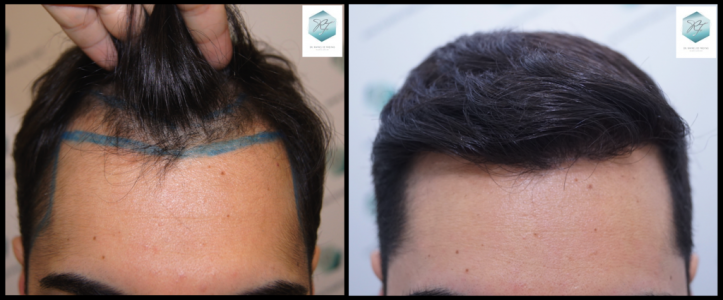 Injerto Capilar Técnica FUE 3105 Grafts (7493 Pelos) 30 trasplante de pelo