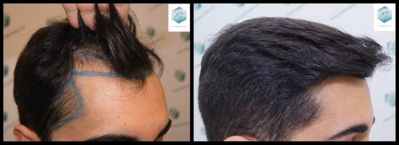 Injerto Capilar Técnica FUE 3105 Grafts (7493 Pelos) 31 trasplante de pelo