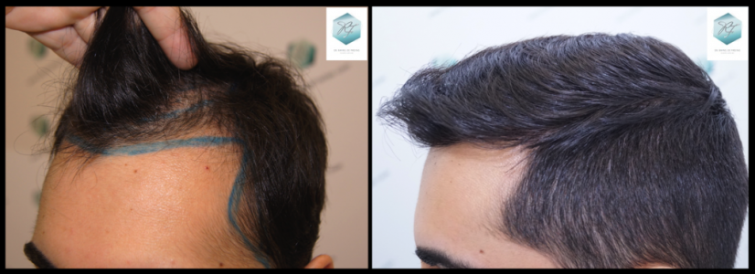 COMPARATIVAS trasplante de pelo