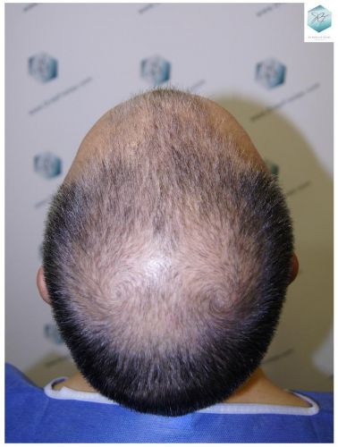 Injerto Capilar Técnica FUE 5235 Grafts (12699 Pelos) 11 trasplante de pelo