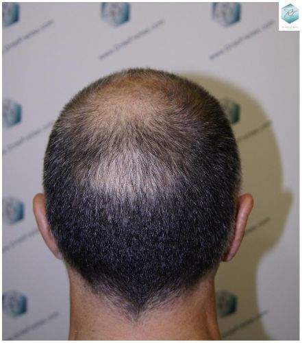 Injerto Capilar Técnica FUE 5235 Grafts (12699 Pelos) 10 injerto capilar