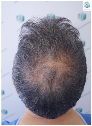 Injerto Capilar Técnica FUE 5235 Grafts (12699 Pelos) 2 injerto capilar