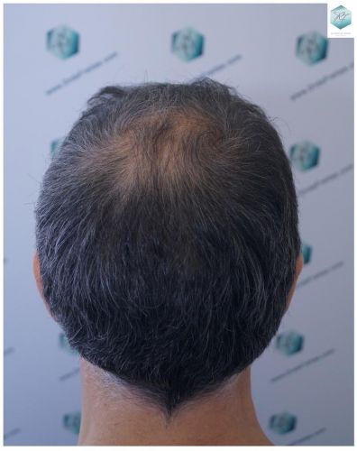Injerto Capilar Técnica FUE 5235 Grafts (12699 Pelos) 30 injerto capilar