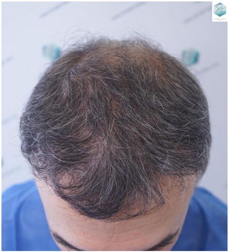 Injerto Capilar Técnica FUE 5235 Grafts (12699 Pelos) 1 injerto capilar