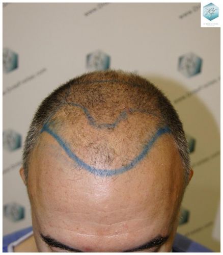 Injerto Capilar Técnica FUE 5235 Grafts (12699 Pelos) 6 injerto capilar