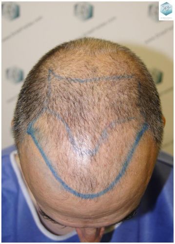 Injerto Capilar Técnica FUE 5235 Grafts (12699 Pelos) 4 injerto capilar