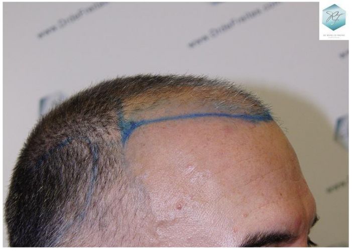 Injerto Capilar Técnica FUE 5235 Grafts (12699 Pelos) 8 injerto capilar