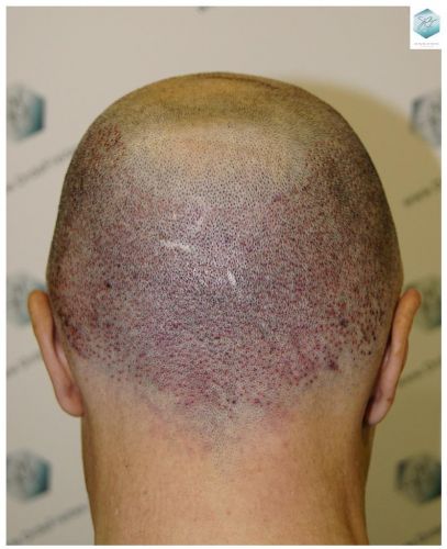 Injerto Capilar Técnica FUE 5235 Grafts (12699 Pelos) 20 injerto capilar