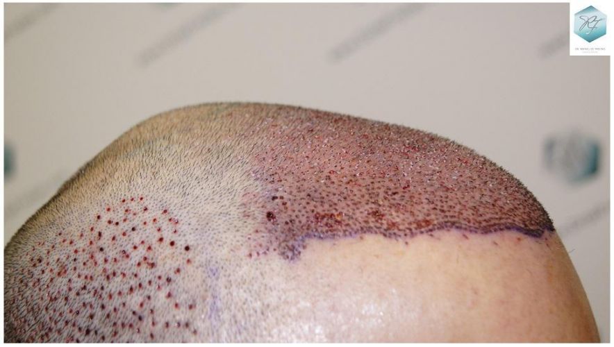 Injerto Capilar Técnica FUE 5235 Grafts (12699 Pelos) 17 injerto capilar