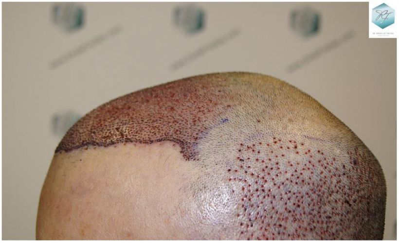 Injerto Capilar Técnica FUE 5235 Grafts (12699 Pelos) 18 injerto capilar