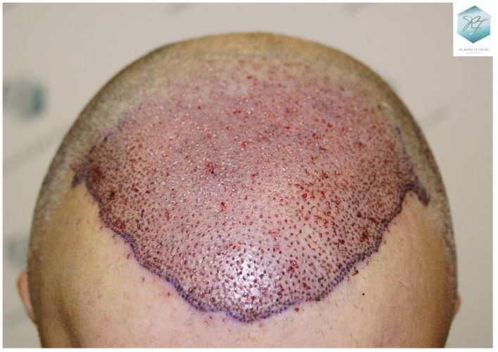 Injerto Capilar Técnica FUE 5235 Grafts (12699 Pelos) 14 injerto capilar