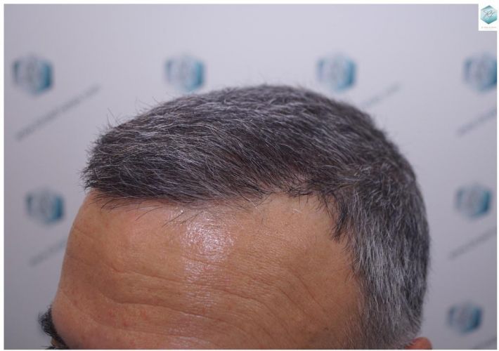 Injerto Capilar Técnica FUE 5235 Grafts (12699 Pelos) 26 TRASPLANTE DE PELO