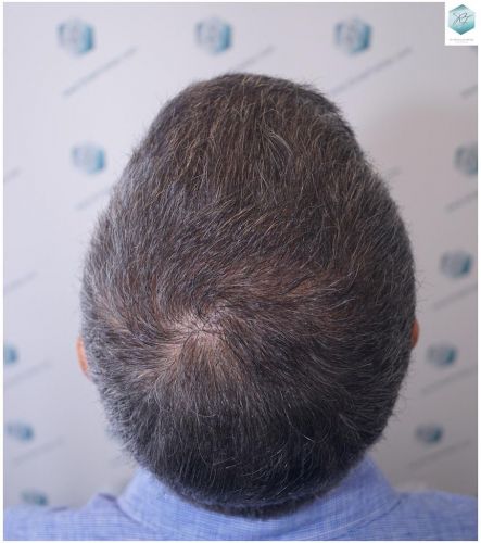 Injerto Capilar Técnica FUE 5235 Grafts (12699 Pelos) 27 caso real trasplante capilar