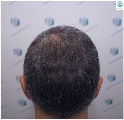 Injerto Capilar Técnica FUE 5235 Grafts (12699 Pelos) 29 caso real trasplante capilar