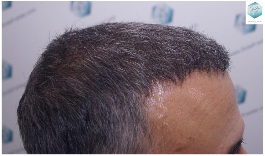 Injerto Capilar Técnica FUE 5235 Grafts (12699 Pelos) 25 caso real trasplante capilar