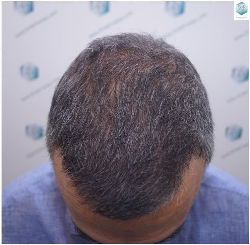 Injerto Capilar Técnica FUE 5235 Grafts (12699 Pelos) 24 caso real trasplante capilar