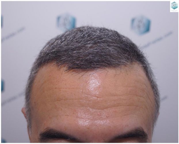 RESULTADOS A LOS 12 MESES resultados reales transplante de pelo