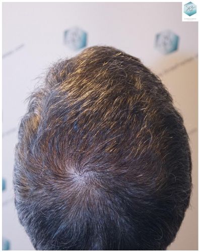 Injerto Capilar Técnica FUE 5235 Grafts (12699 Pelos) 28 resultados reales transplante de pelo