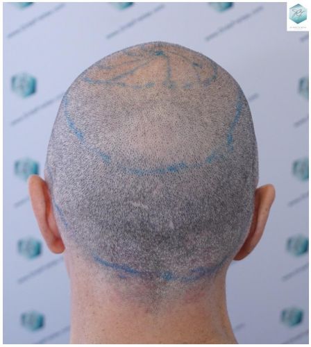 Injerto Capilar Técnica FUE 5235 Grafts (12699 Pelos) 12 injerto capilar
