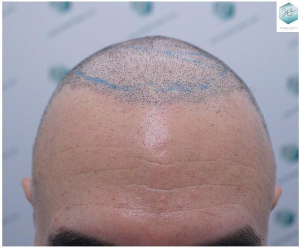 Injerto Capilar Técnica FUE 5235 Grafts (12699 Pelos) 3 injerto capilar