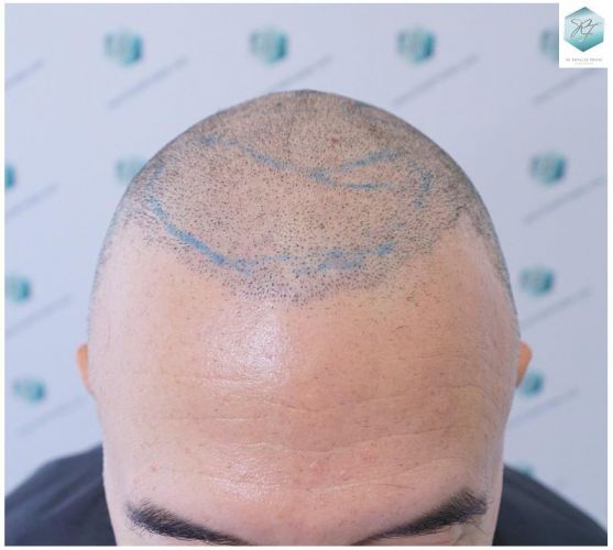 Injerto Capilar Técnica FUE 5235 Grafts (12699 Pelos) 7 injerto capilar