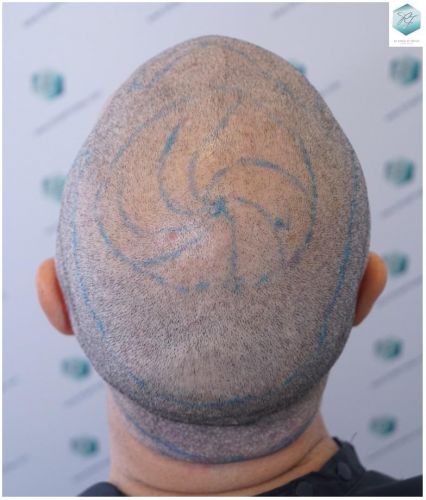 Injerto Capilar Técnica FUE 5235 Grafts (12699 Pelos) 13 injerto capilar