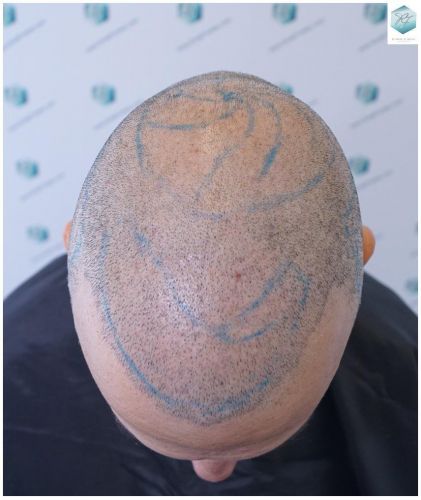 Injerto Capilar Técnica FUE 5235 Grafts (12699 Pelos) 5 injerto capilar