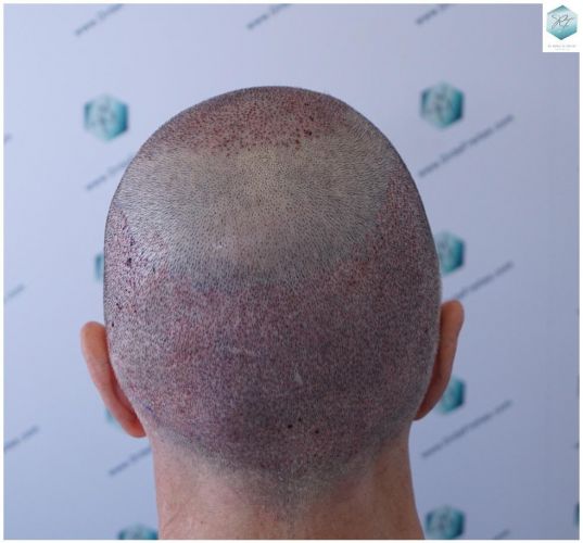Injerto Capilar Técnica FUE 5235 Grafts (12699 Pelos) 23 injerto capilar