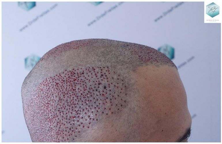 Injerto Capilar Técnica FUE 5235 Grafts (12699 Pelos) 16 TRASPLANTE DE PELO
