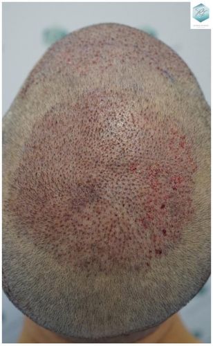 Injerto Capilar Técnica FUE 5235 Grafts (12699 Pelos) 22 TRASPLANTE DE PELO