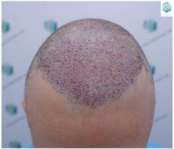 Injerto Capilar Técnica FUE 5235 Grafts (12699 Pelos) 15 TRASPLANTE DE PELO