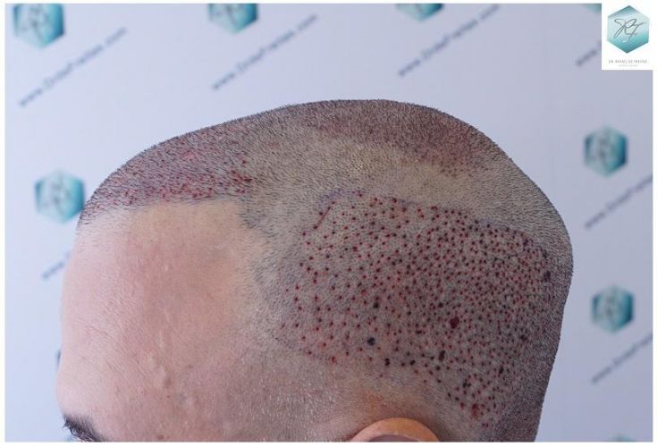 Injerto Capilar Técnica FUE 5235 Grafts (12699 Pelos) 19 TRASPLANTE DE PELO