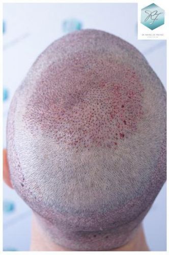 Injerto Capilar Técnica FUE 5235 Grafts (12699 Pelos) 21 TRASPLANTE DE PELO