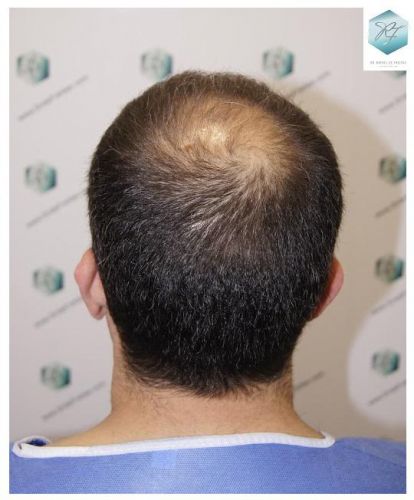 Injerto Capilar Técnica FUE 2036 Grafts (4761 Pelos) 2 resultados reales transplante de pelo