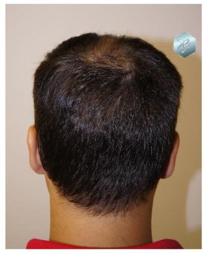 injerto pelo en españa