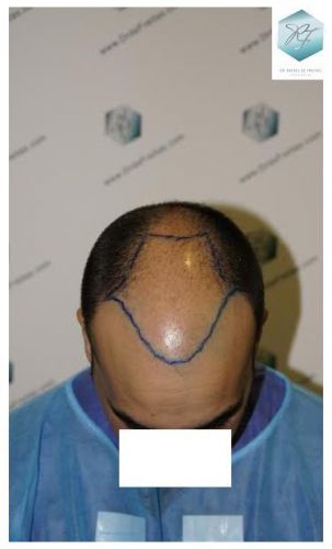 evitar la caída del cabello