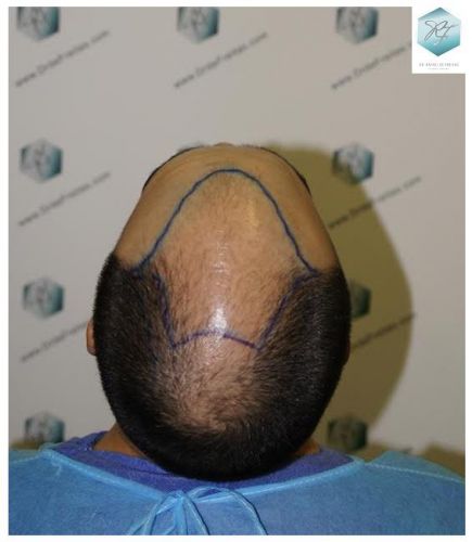 evitar la caída del cabello