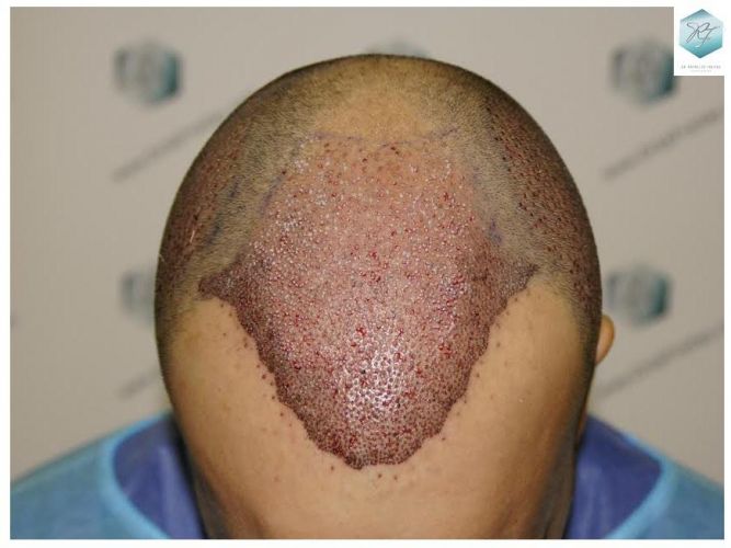 injerto pelo en españa