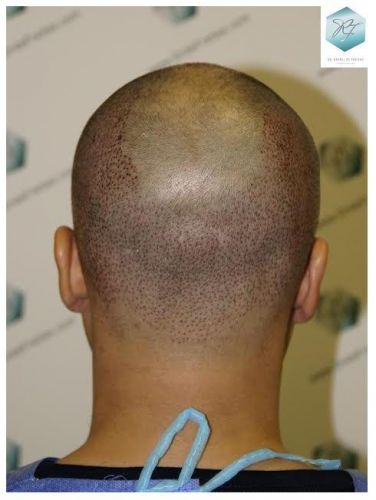 injerto pelo en españa