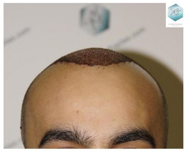 injerto pelo en españa