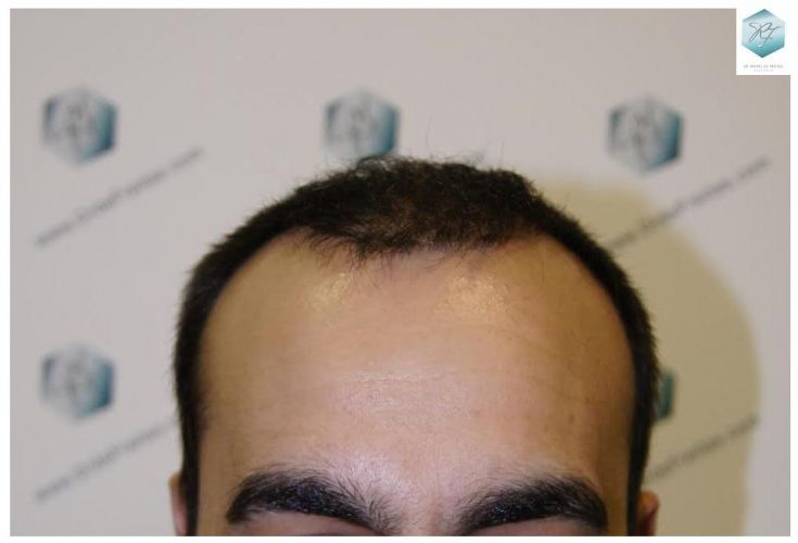 injerto pelo en españa