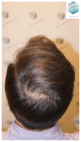 injerto pelo en españa