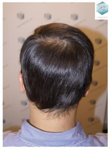 injerto pelo en españa