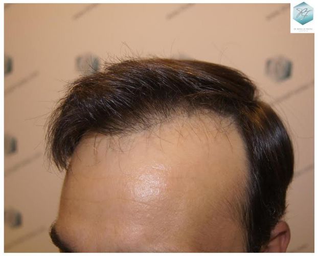 injerto pelo en españa