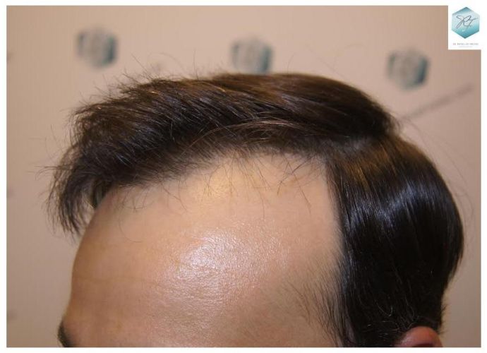 injerto pelo en españa