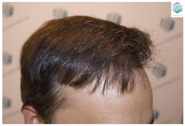 injerto pelo en españa