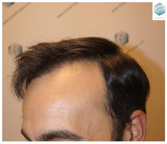 injerto pelo en españa
