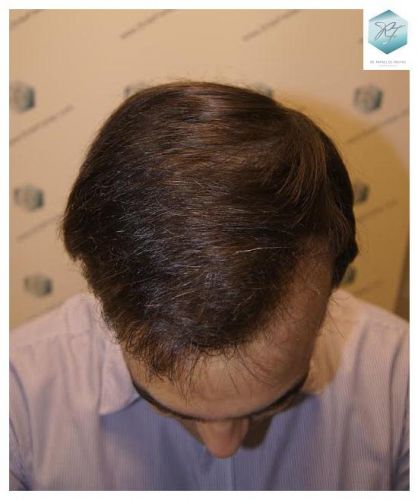injerto pelo en españa