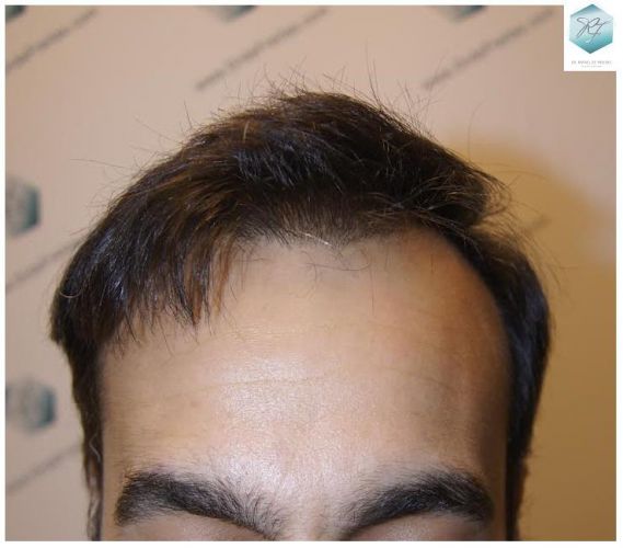 injerto pelo en españa