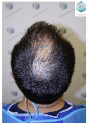 injerto pelo en españa